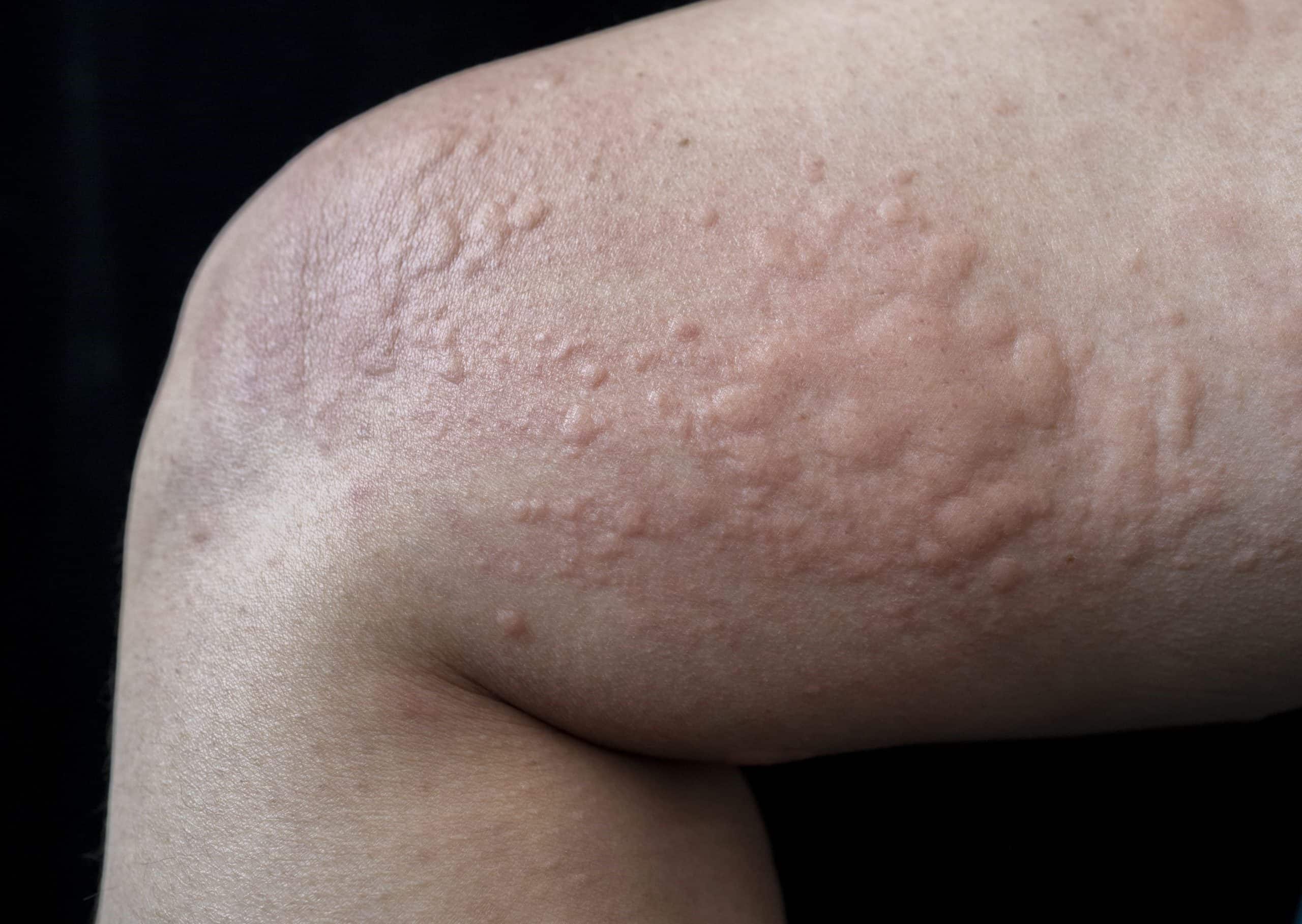 50 Facts About Urticaria Facts 50 Facts About Urticaria Facts