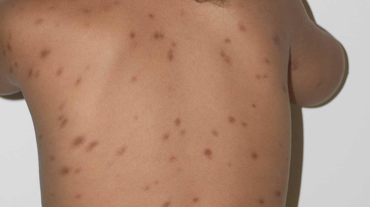 50-facts-about-urticaria-pigmentosa