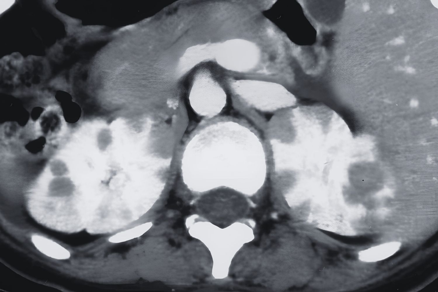 50-facts-about-uterine-sarcoma