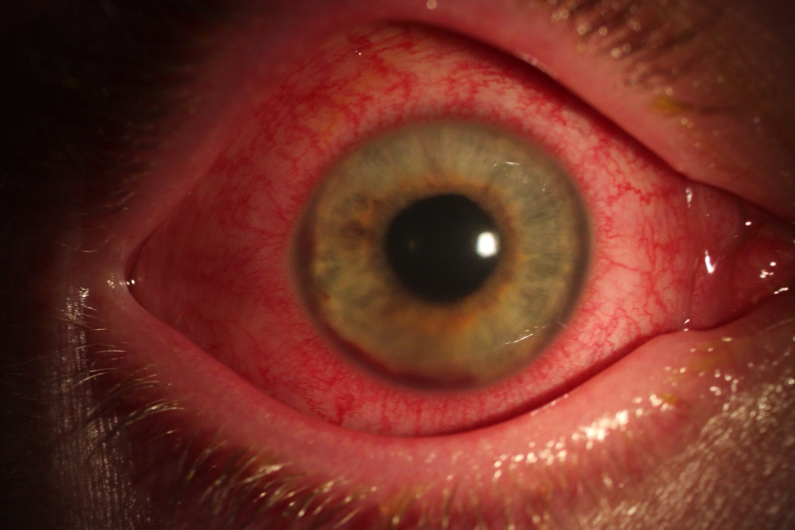 50-facts-about-uveitis