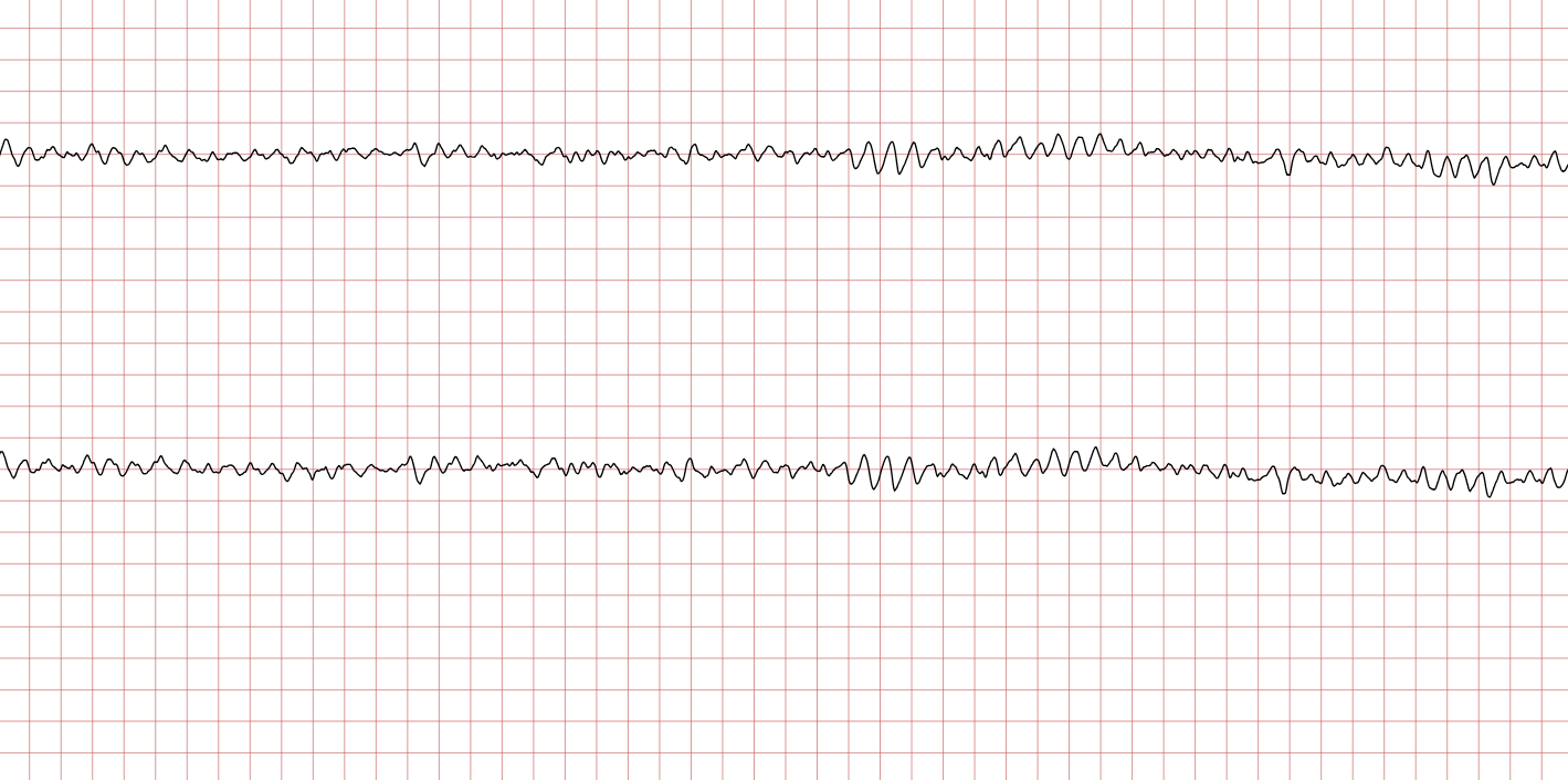 50-facts-about-ventricular-fibrillation