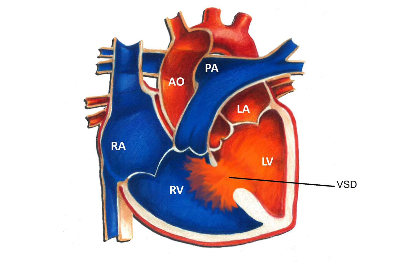 50-facts-about-ventricular-septal-defect