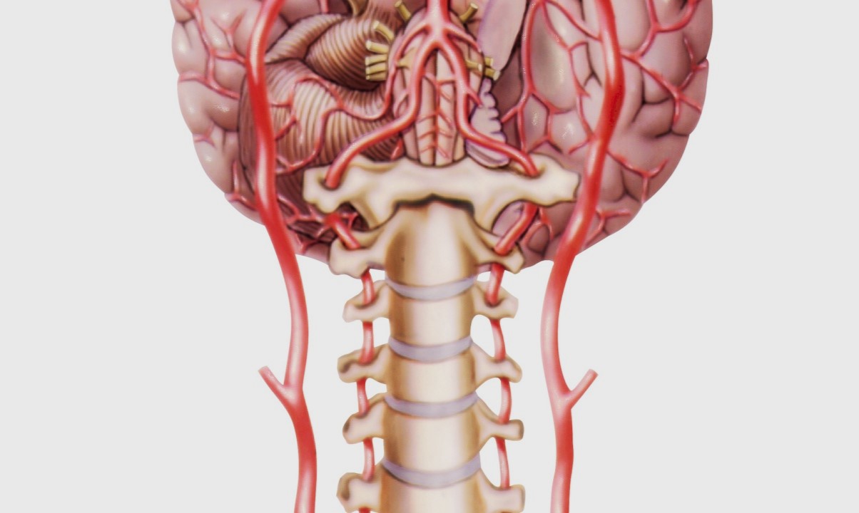 50-facts-about-vertebrobasilar-insufficiency