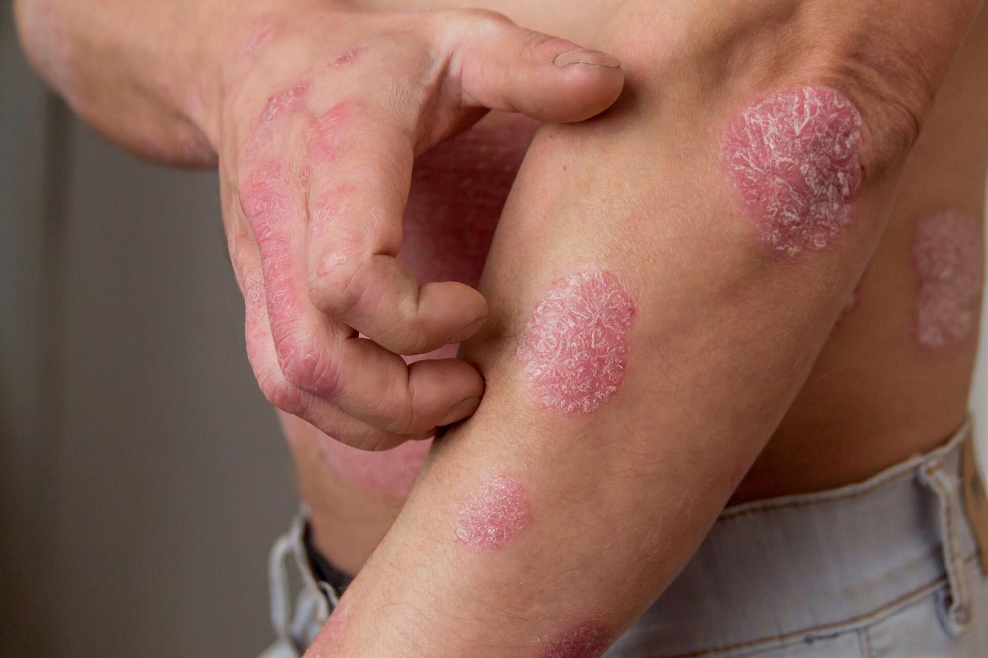 25-facts-about-congenital-skin-disorder