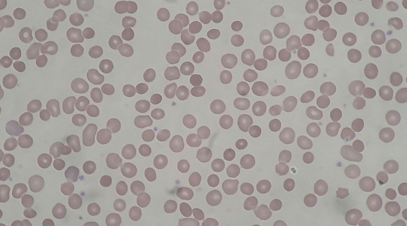 25-facts-about-congenital-spherocytic-hemolytic-anemia