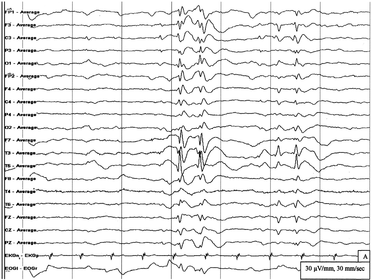 25 Facts About Continuous Spike-Wave During Slow Sleep - Facts.net