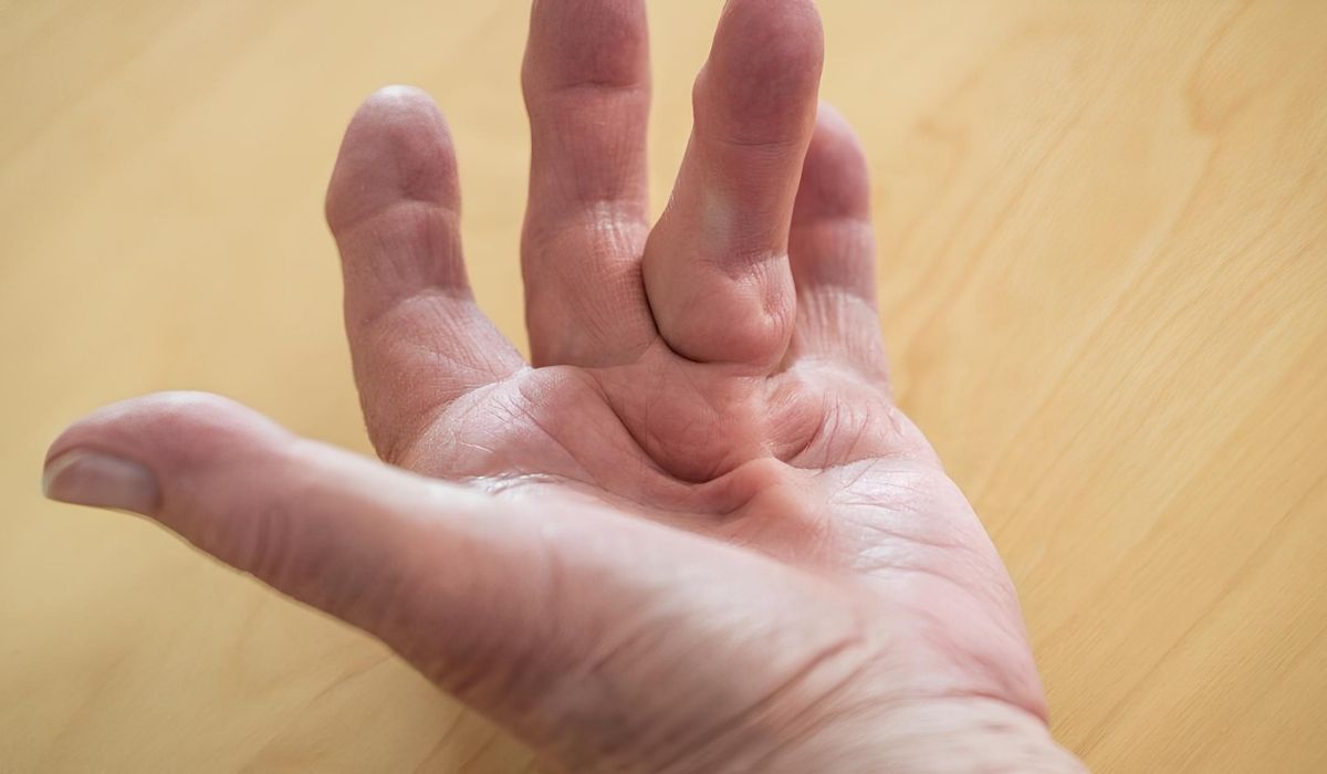 25-facts-about-contractures-hyperkeratosis-lethal