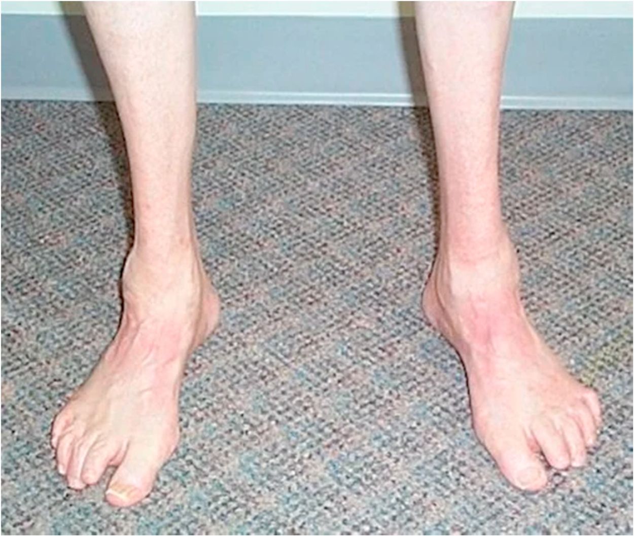 25-facts-about-contractures-of-feet-muscle-atrophy-oculomotor-apraxia