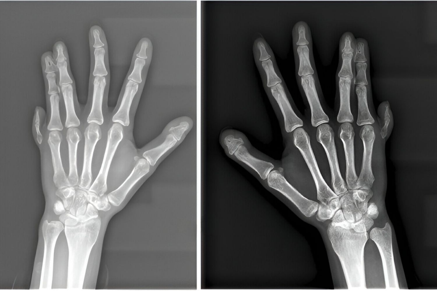 25-facts-about-crossed-polysyndactyly