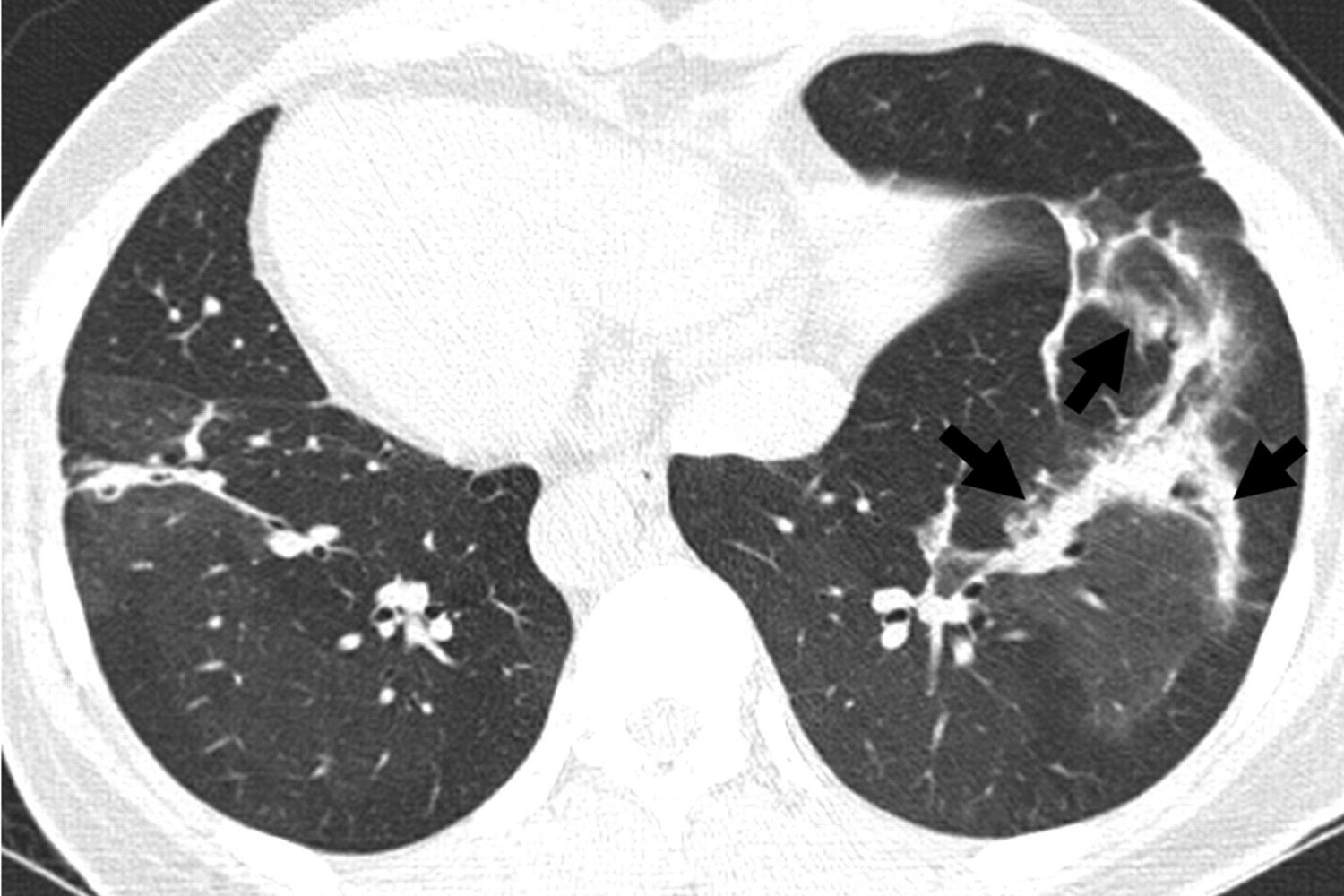 25-facts-about-cryptogenic-organized-pneumopathy