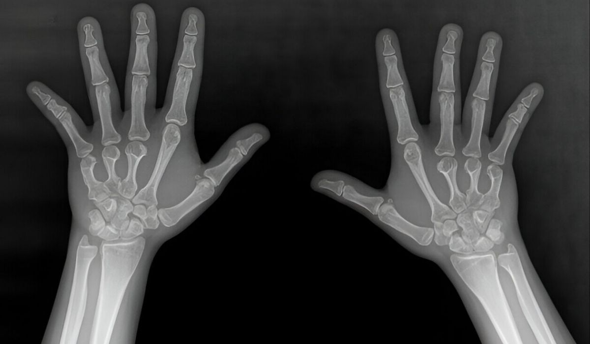 25-facts-about-cryptomicrotia-brachydactyly