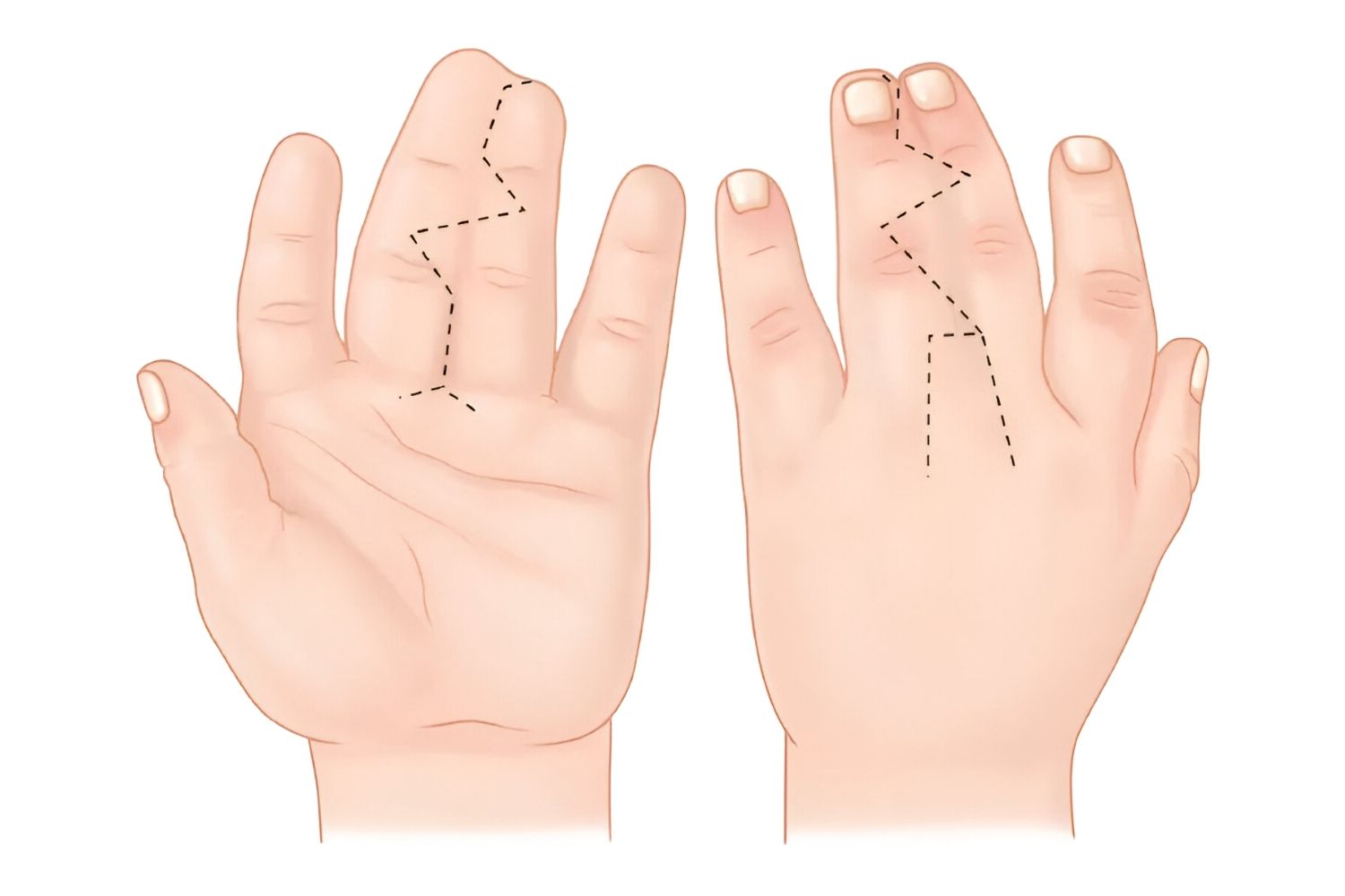 25-facts-about-cryptophthalmos-syndactyly