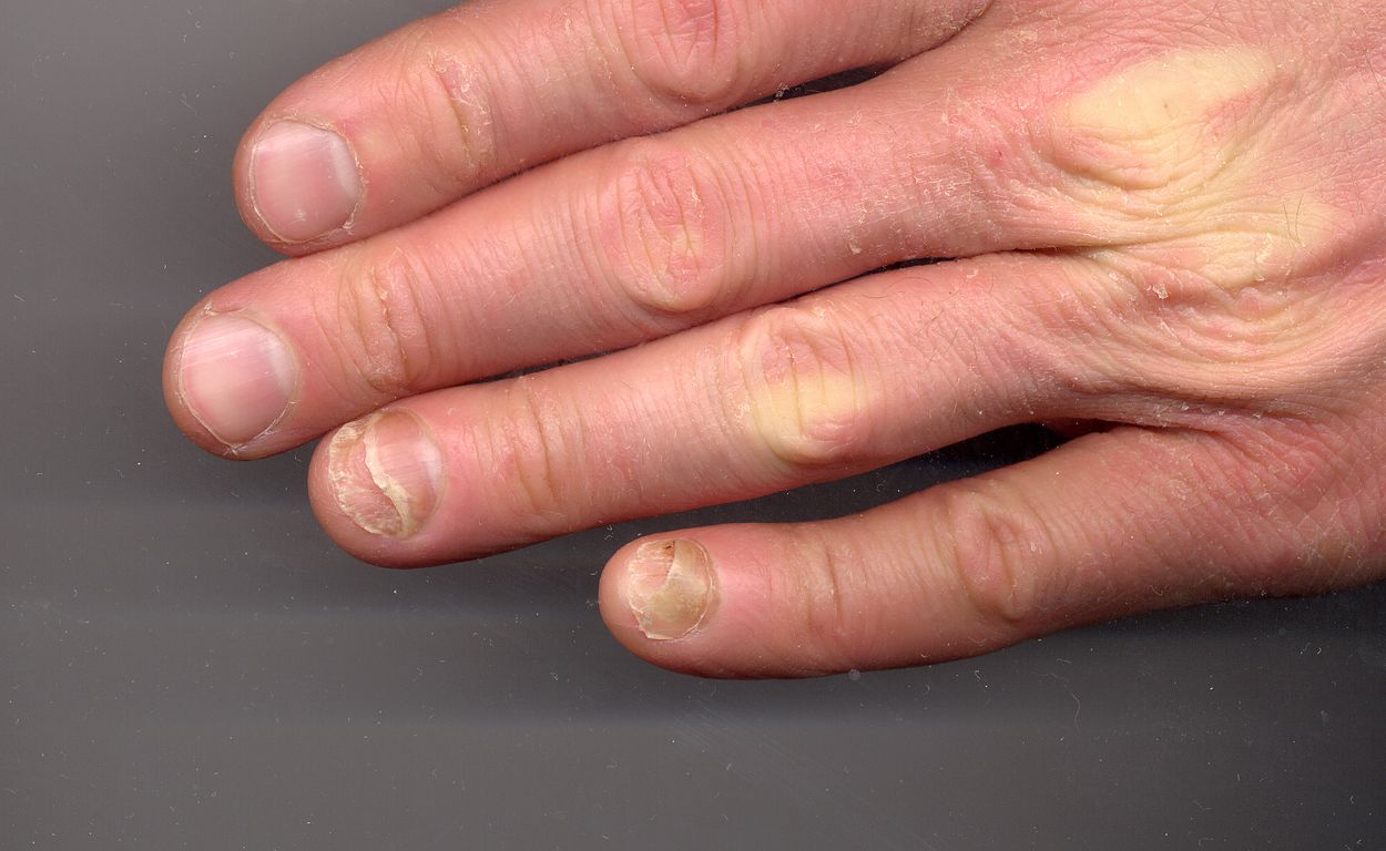 25-facts-about-double-fingernail-of-fifth-finger