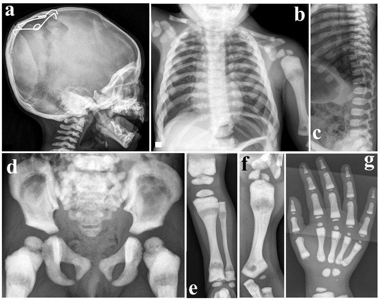 25-facts-about-dysosteosclerosis