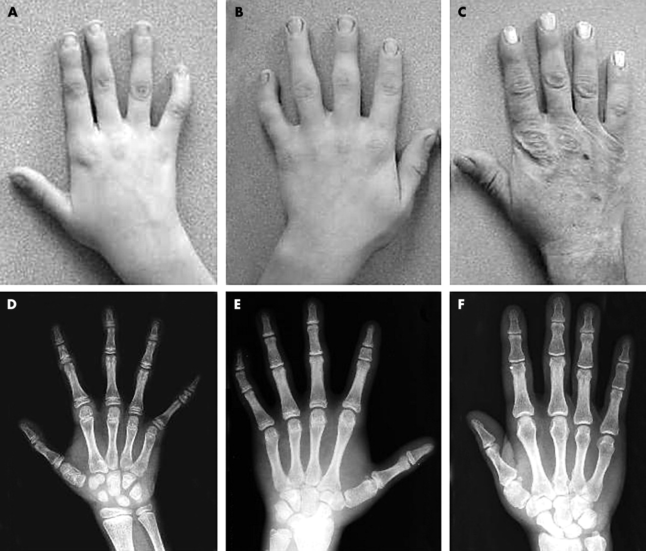 25-facts-about-dysostosis-peripheral