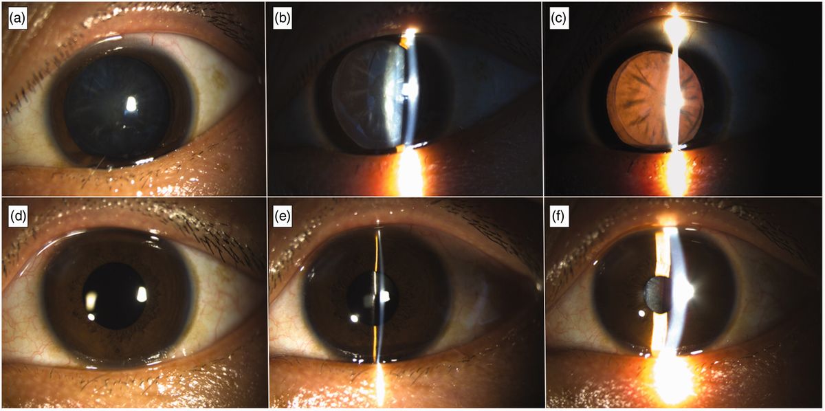 25-facts-about-enamel-hypoplasia-cataract-hydrocephaly