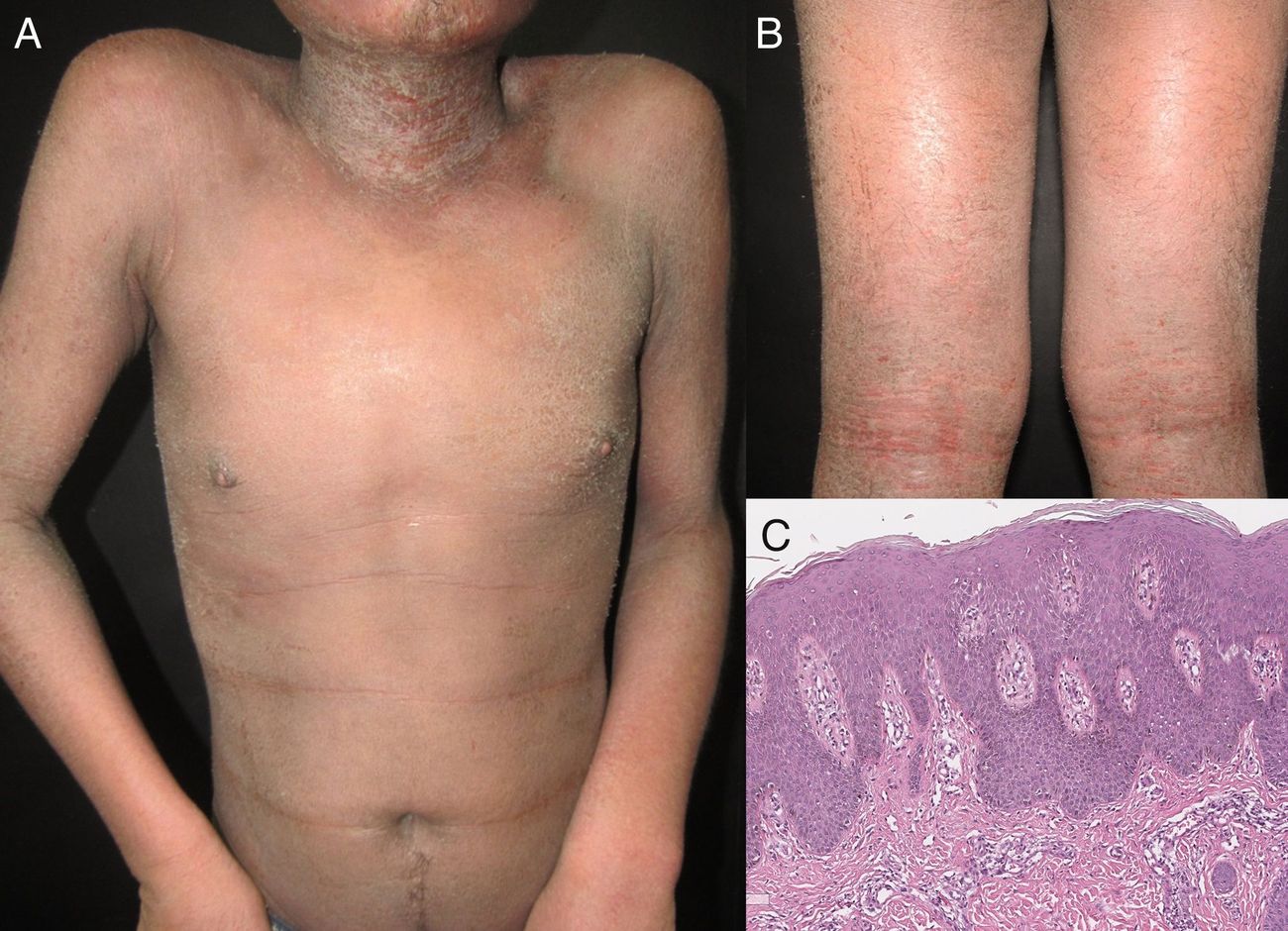 25-facts-about-erythroderma-lethal-congenital