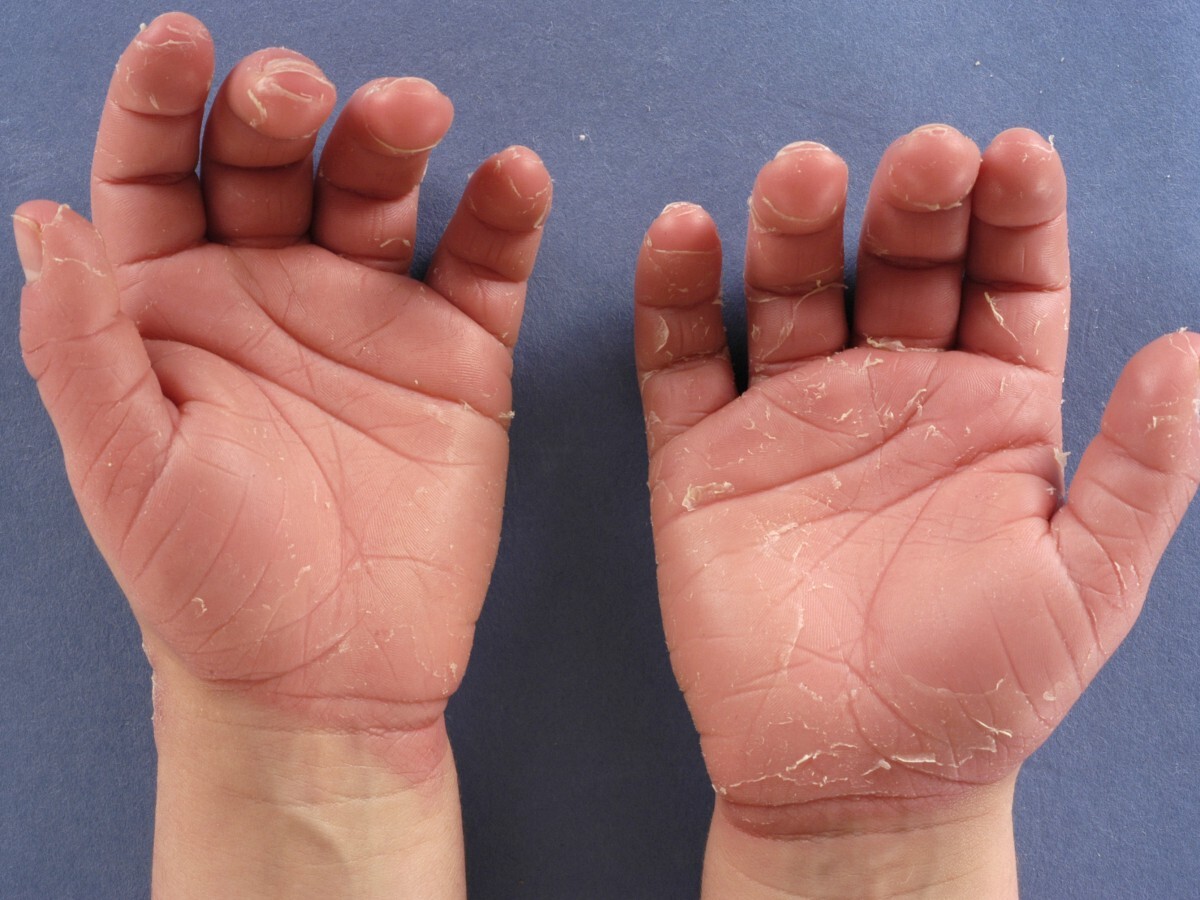 25-facts-about-erythrokeratolysis-hiemalis-ichthyosis