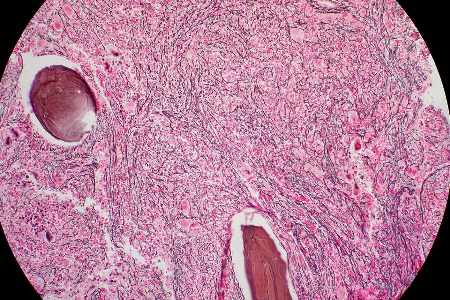 25-facts-about-familial-myelofibrosis