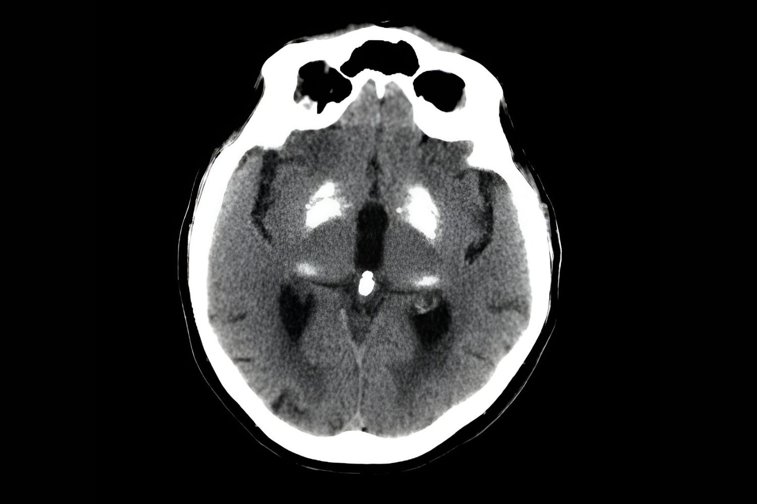 25-facts-about-ferrocalcinosis-cerebro-vascular