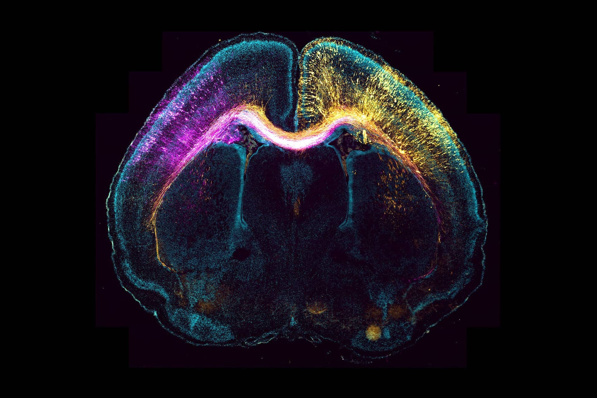 25-facts-about-generalized-malformations-in-neuronal-migration