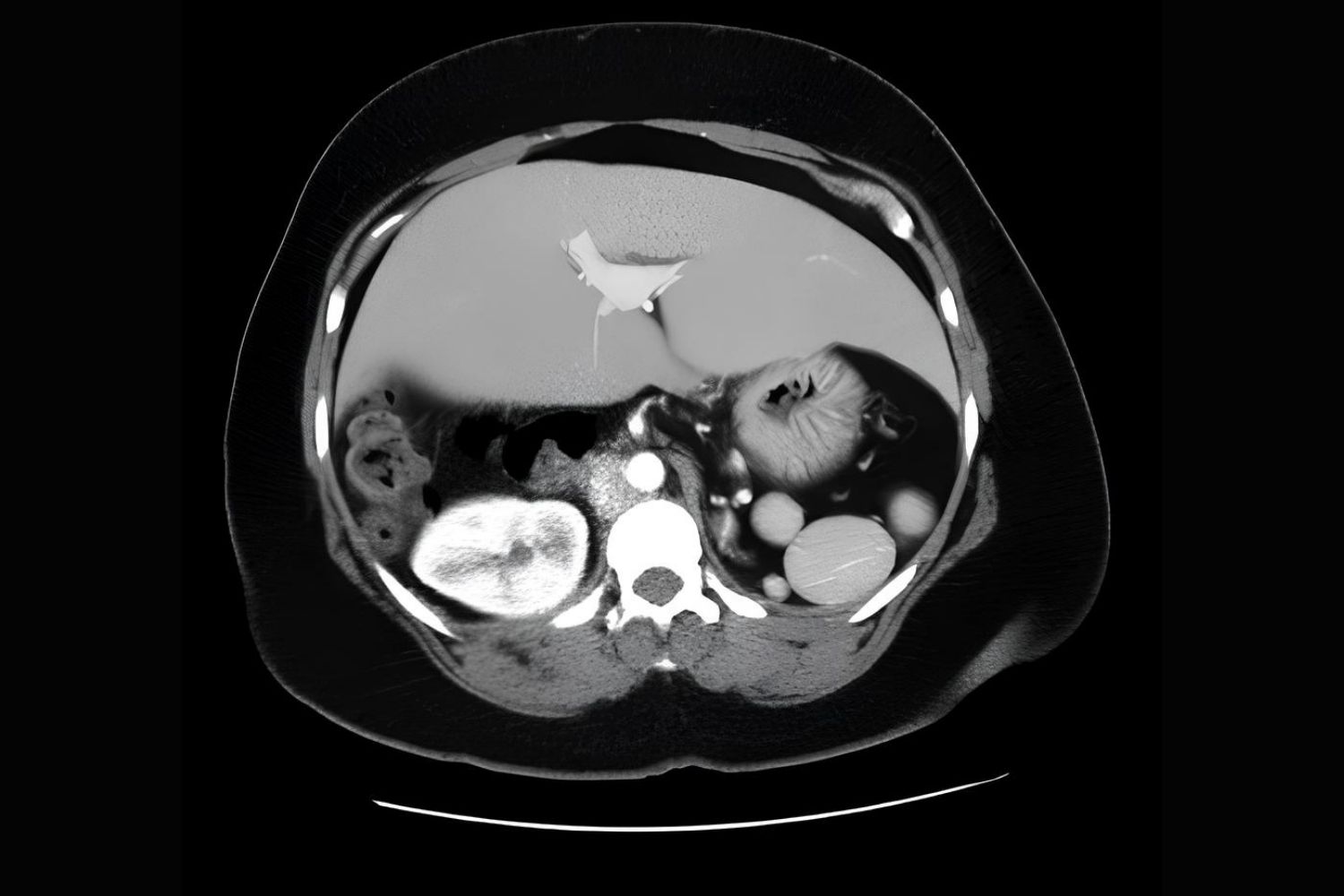 25-facts-about-heterotaxy-with-polysplenia-or-asplenia