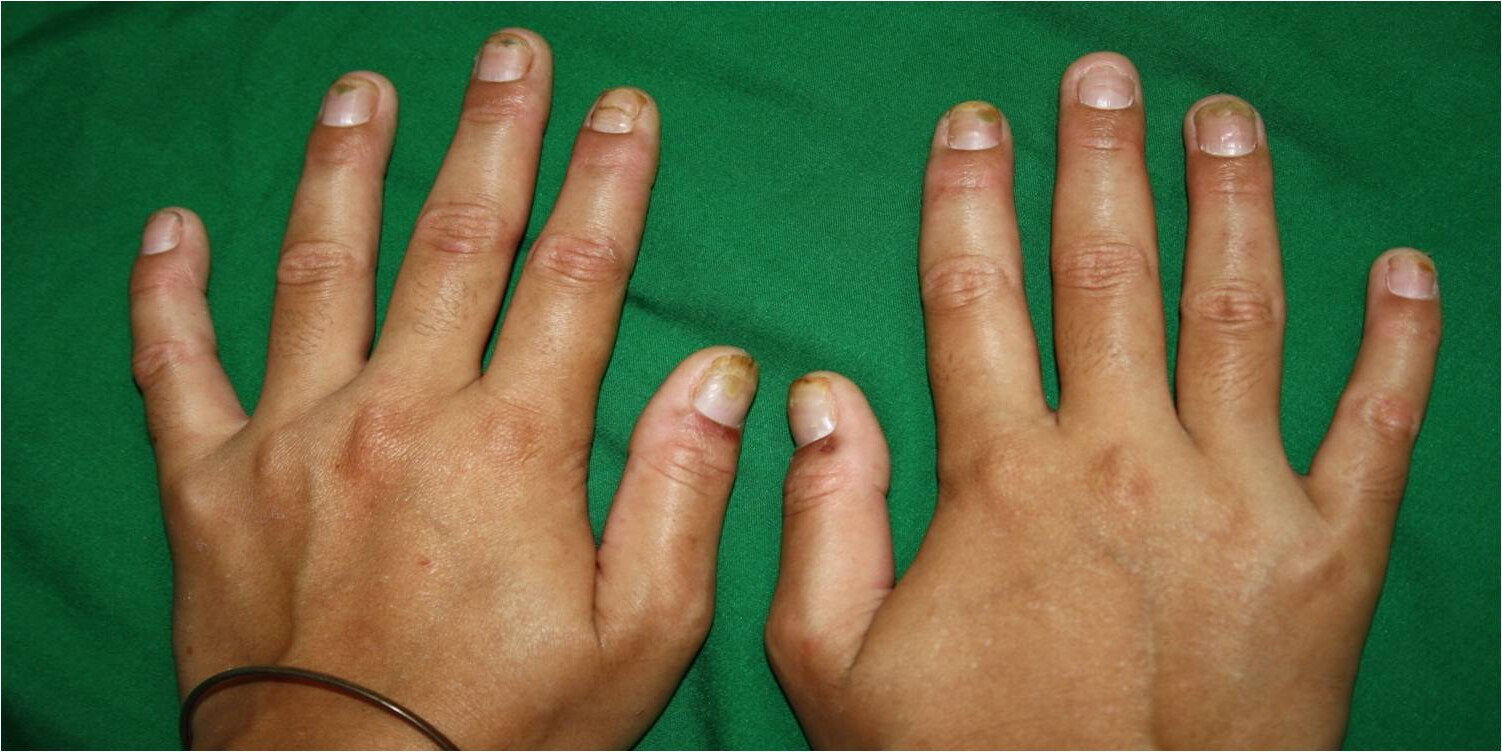 25-facts-about-hypodontia-dysplasia-of-nails