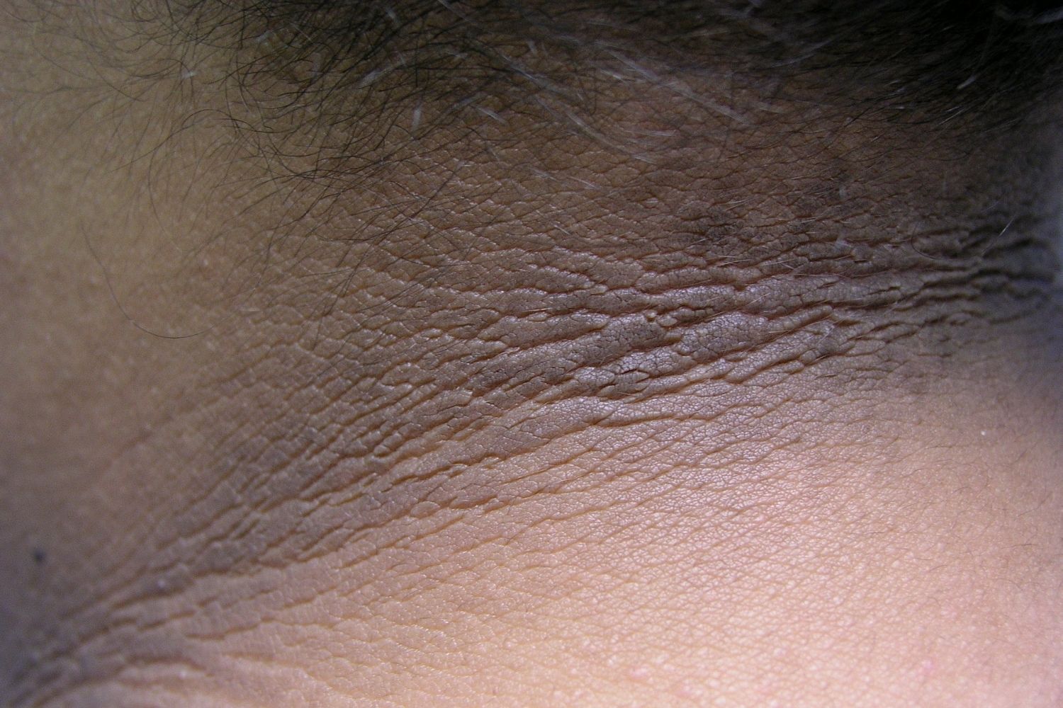 25-facts-about-insulin-resistant-acanthosis-nigricans-type-a