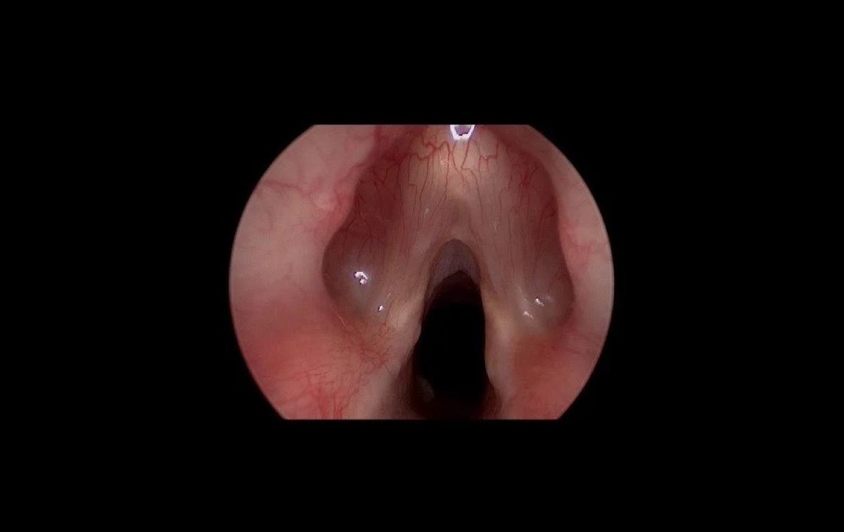 25-facts-about-laryngeal-web-congenital-heart-disease-short-stature