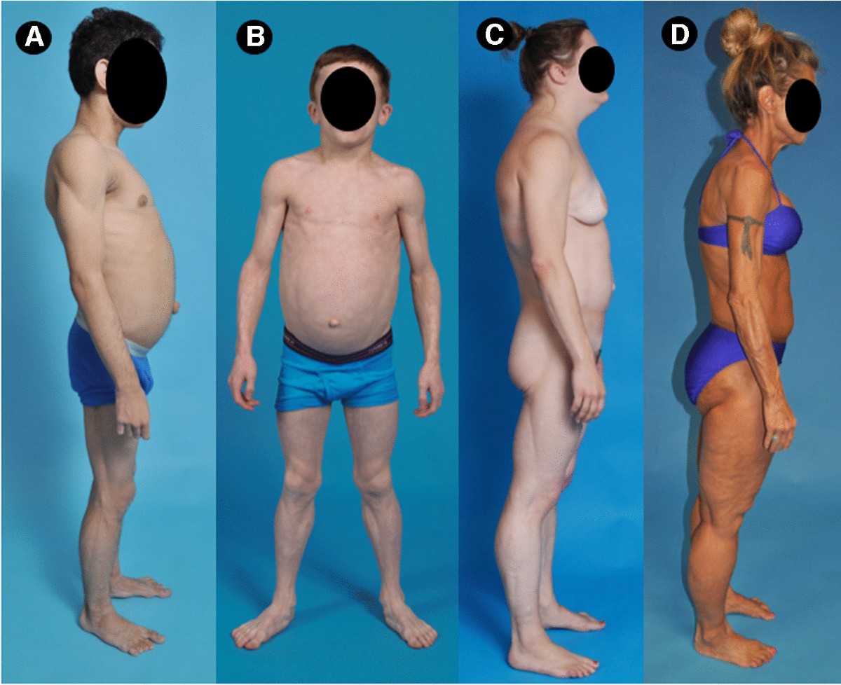 25-facts-about-lipodystrophy-rieger-anomaly-diabetes