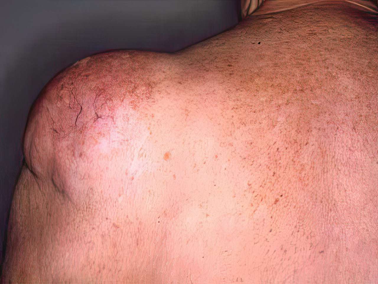 25-facts-about-lipomatosis-familial-benign-cervical