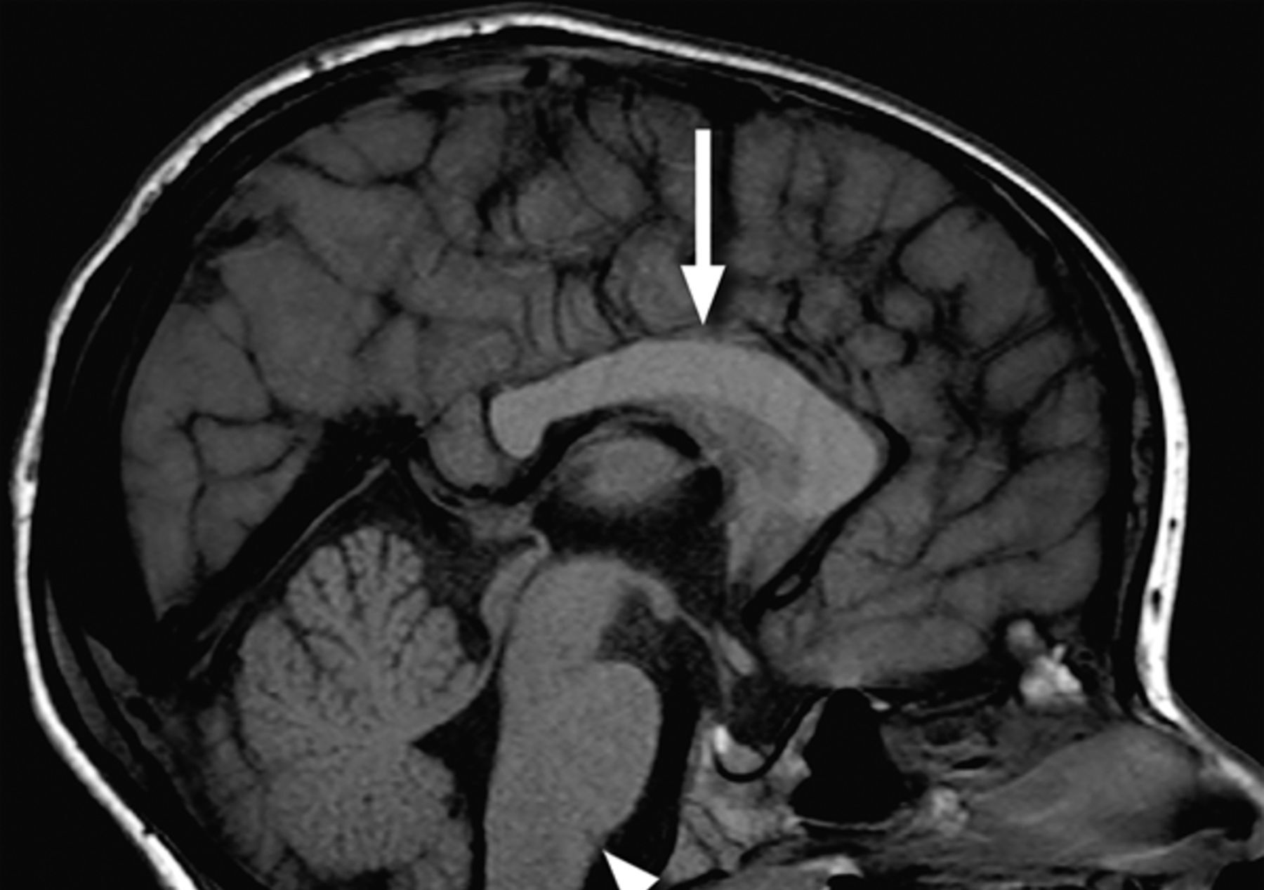 25-facts-about-lissencephaly-immunodeficiency