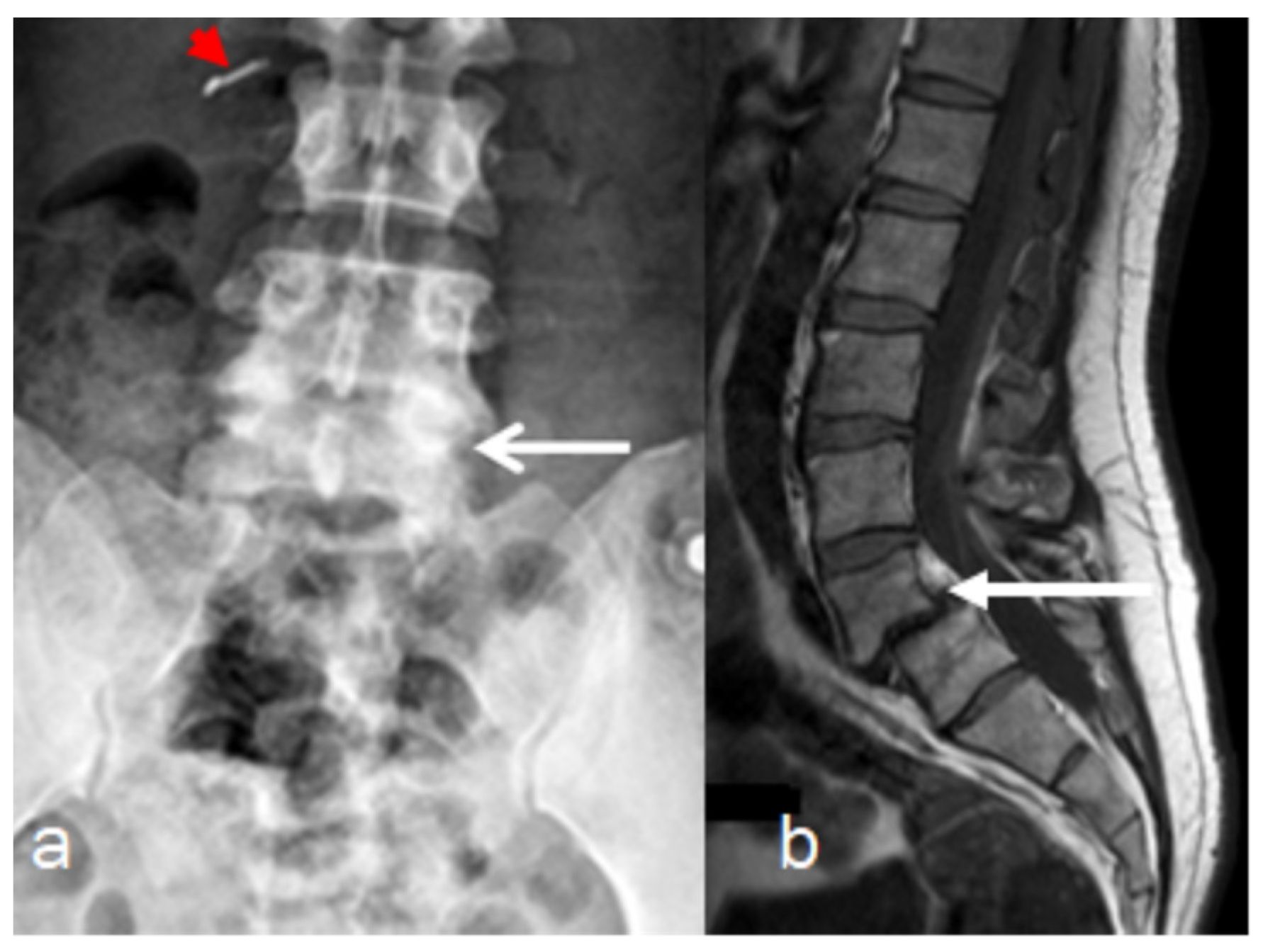 25-facts-about-lumbar-malsegmentation-short-stature