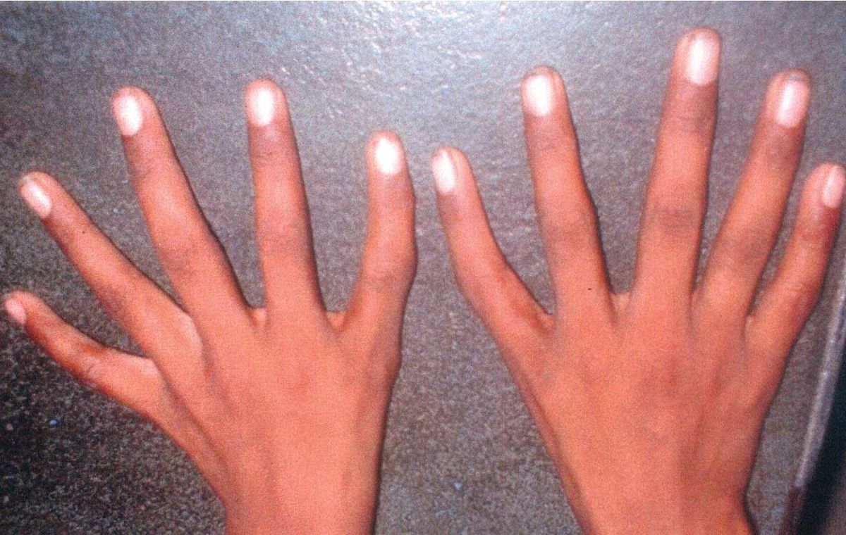 25-facts-about-lung-agenesis-heart-defect-thumb-anomalies