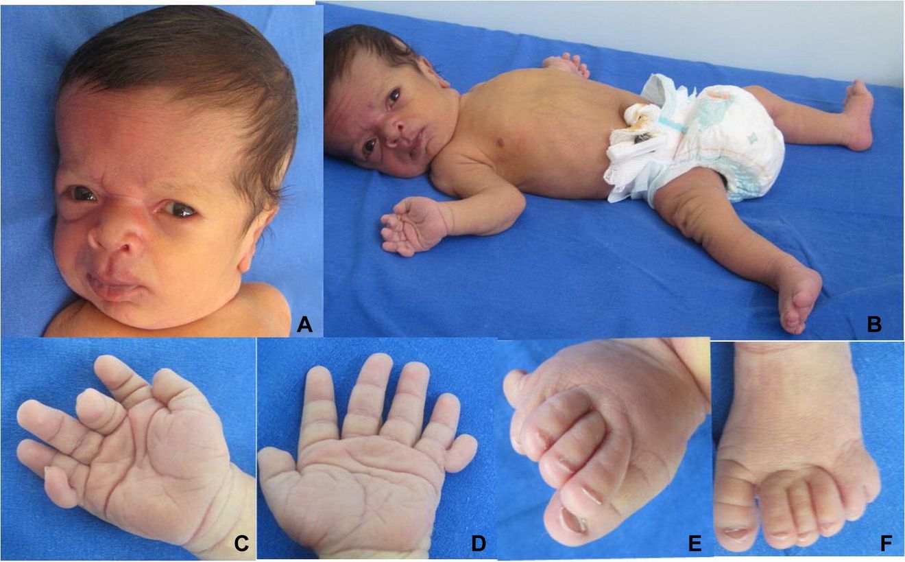 25-facts-about-macrocephaly-pigmentation-large-hands-feet