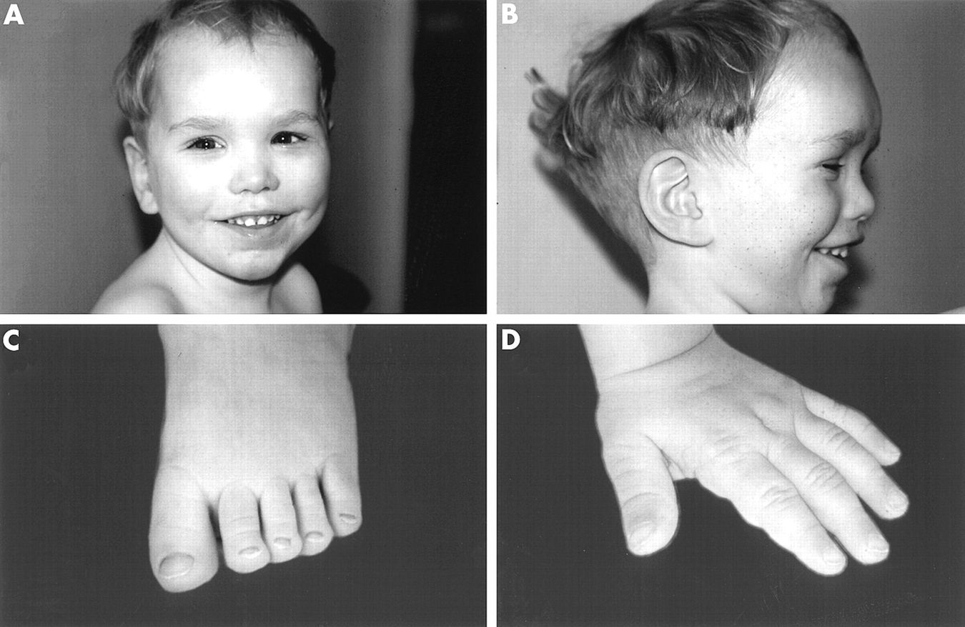 25-facts-about-macrosomia-developmental-delay-dysmorphism