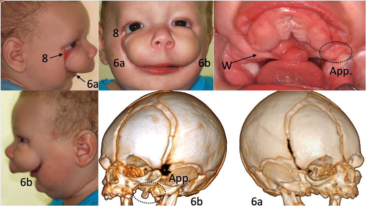 25-facts-about-macrosomia-microphthalmia-cleft-palate