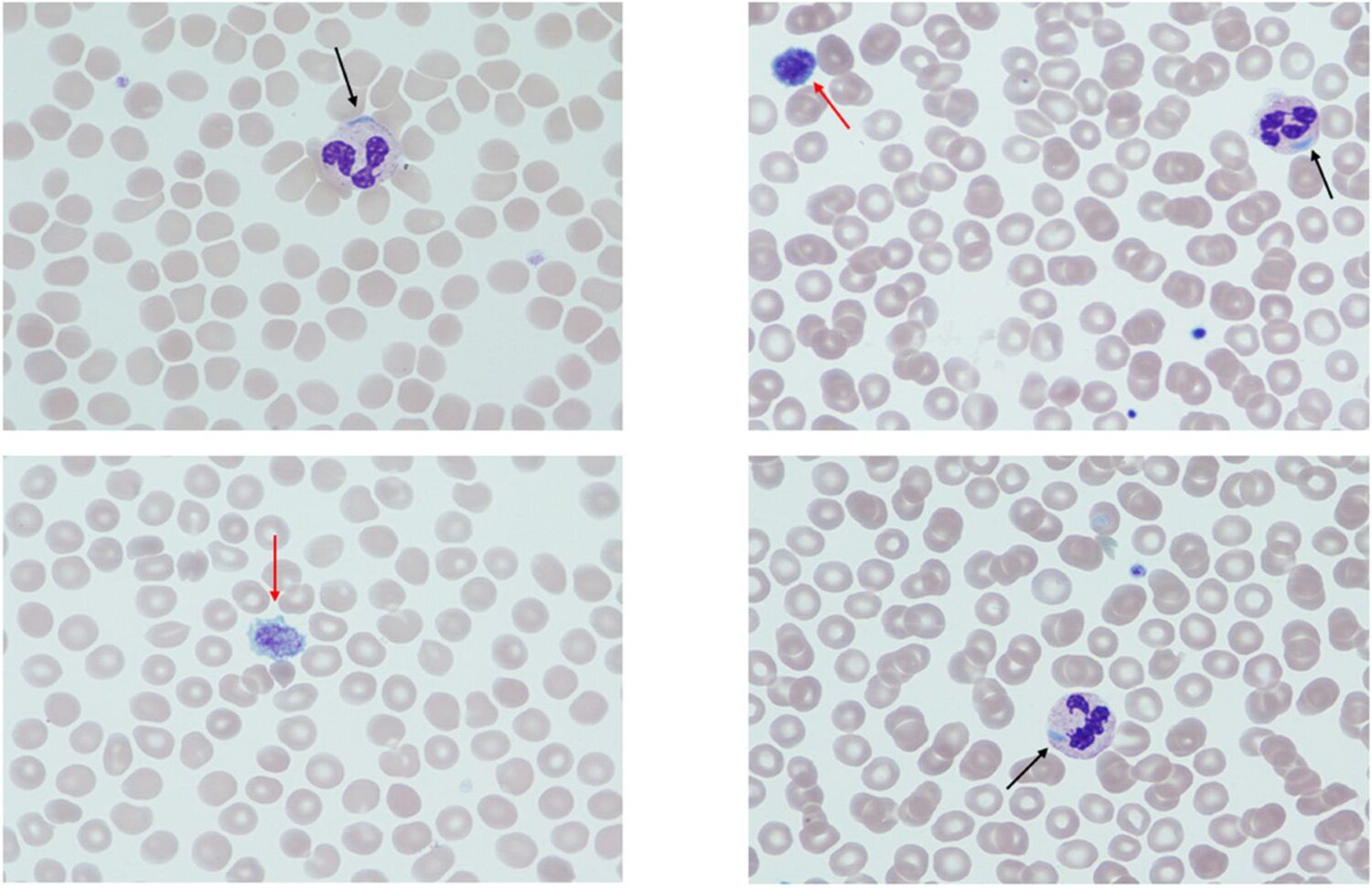 25-facts-about-macrothrombocytopenia-with-leukocyte-inclusions