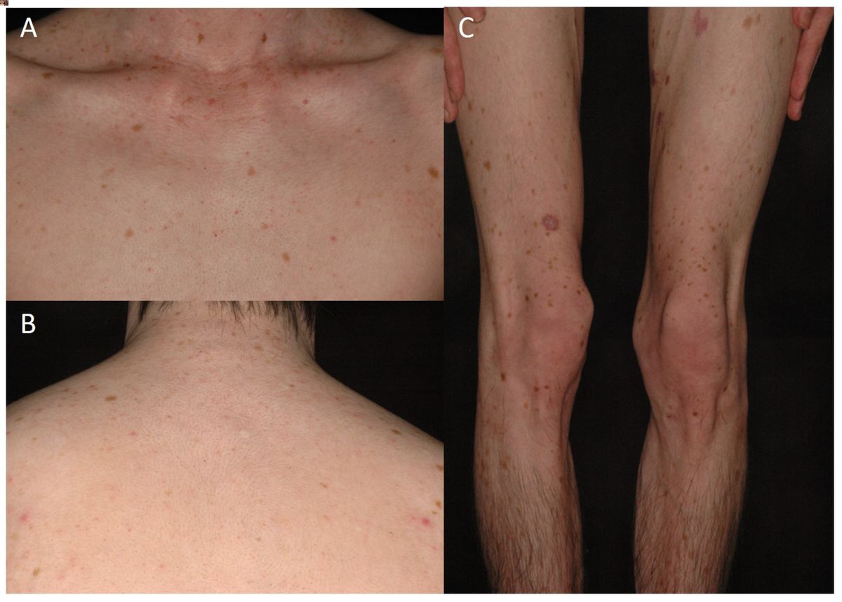 25-facts-about-macules-hereditary-congenital-hypopigmented-and-hyperpigmented