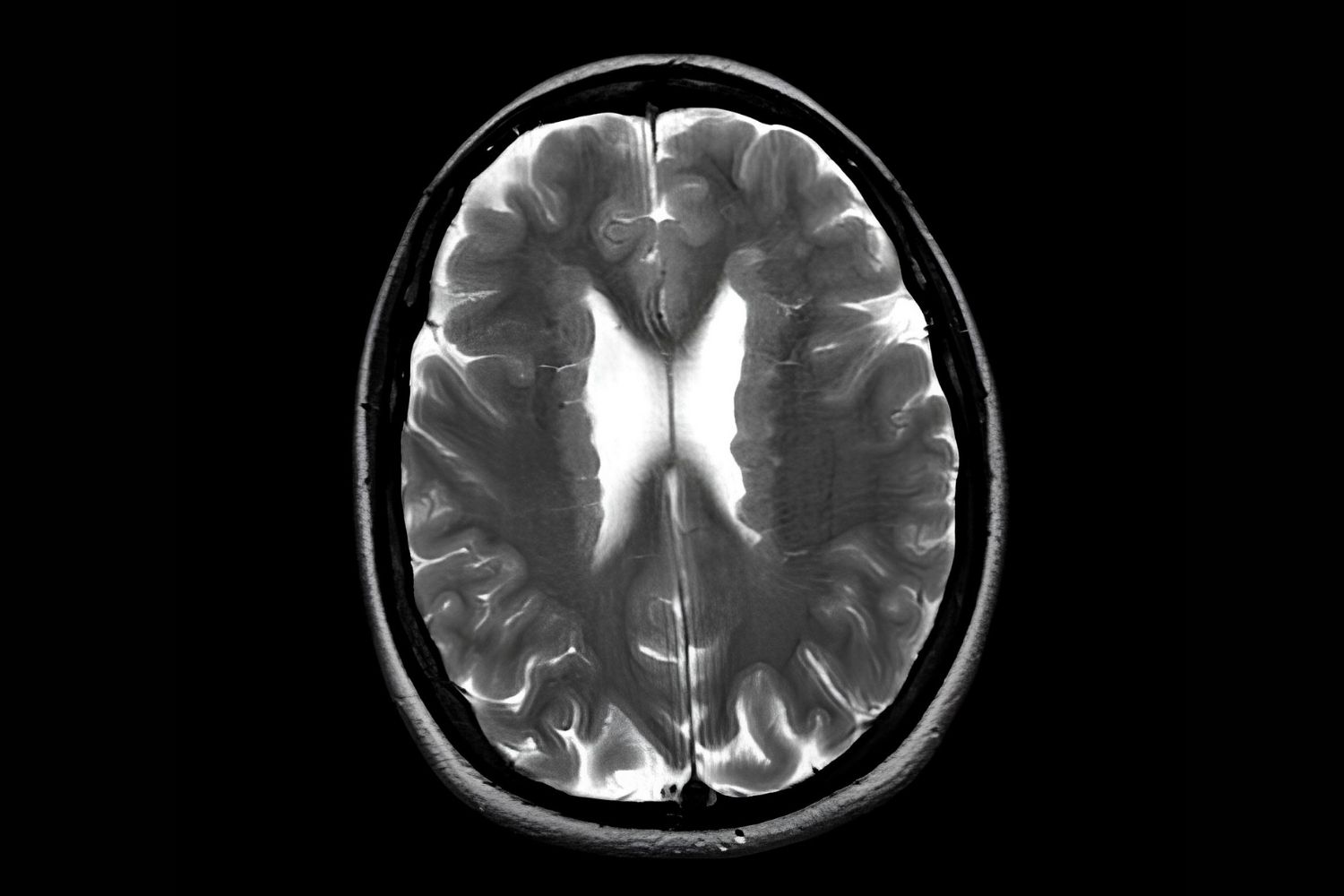 25-facts-about-marginal-glioneuronal-heterotopia