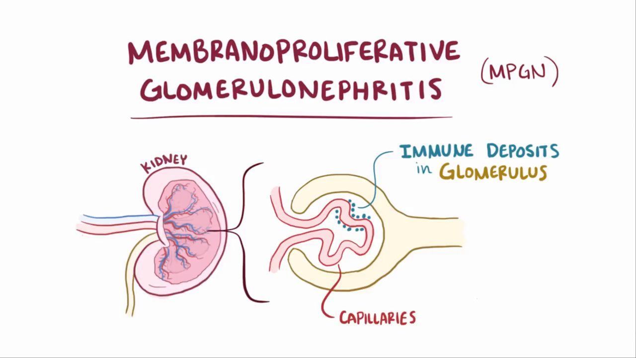 25-facts-about-membranoproliferative-glomerulonephritis-type-ii