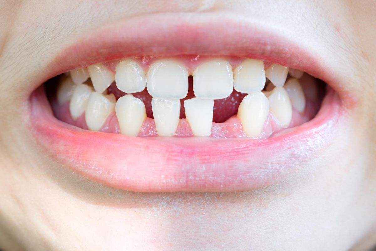 25-facts-about-microdontia-hypodontia-short-stature