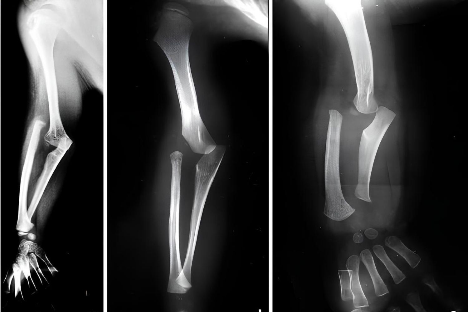 25-facts-about-micromelic-dysplasia-dislocation-of-radius