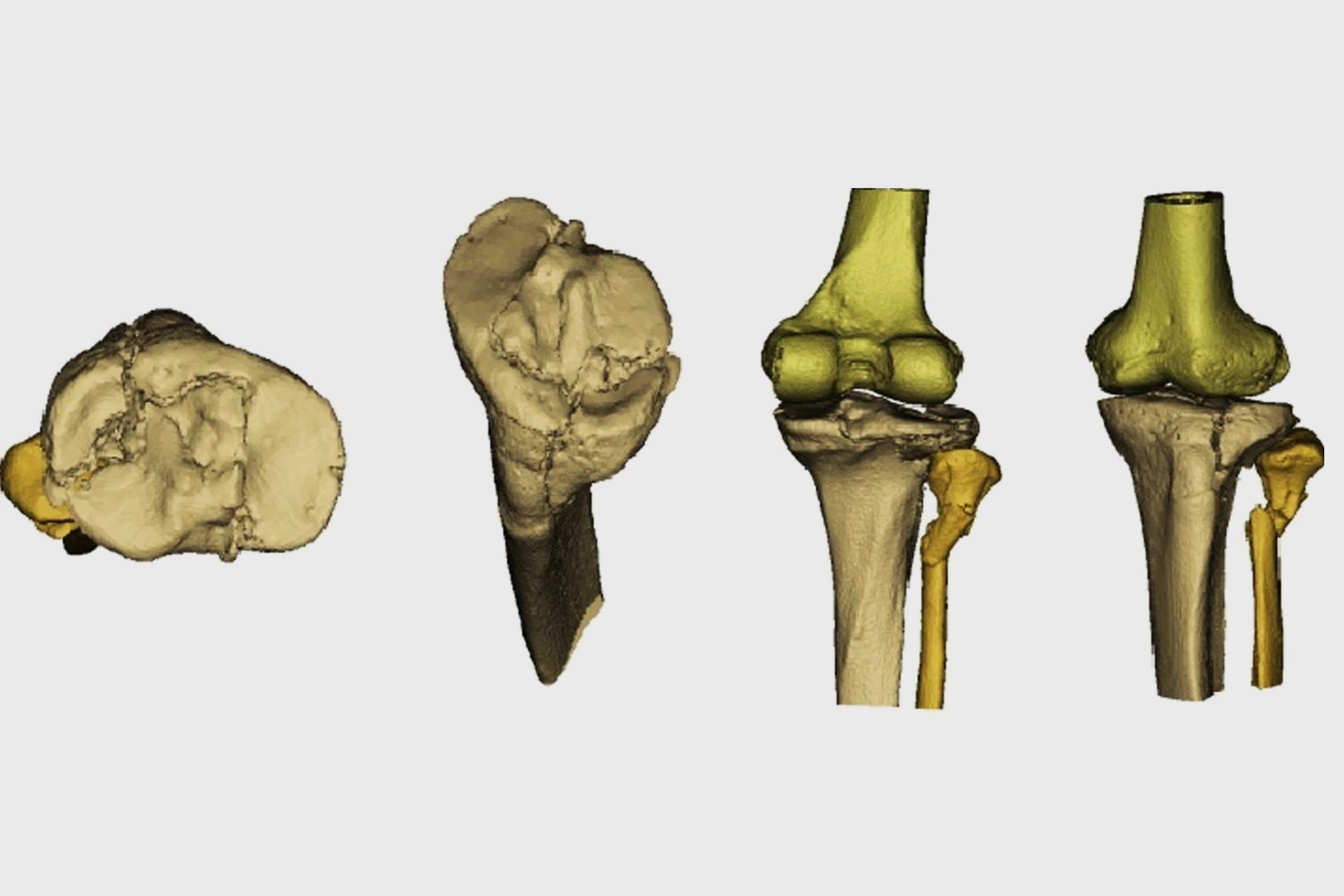 25-facts-about-muller-ao-classification-of-fractures