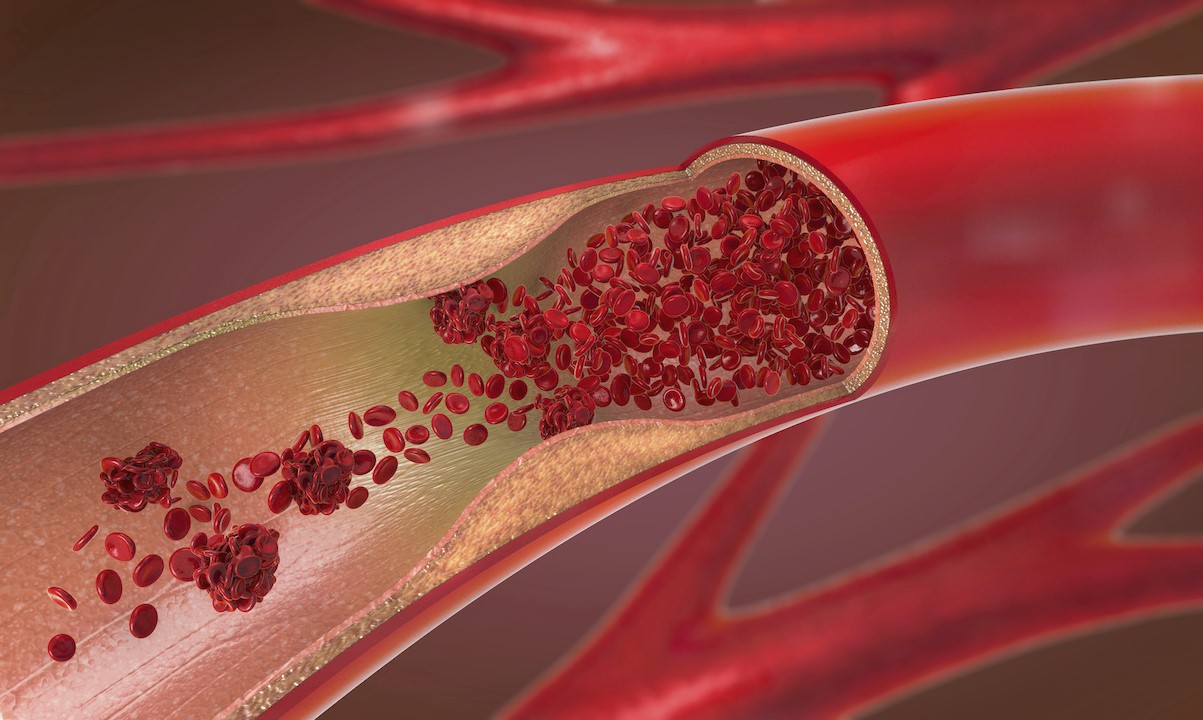 25-facts-about-muscular-fibrosis-multifocal-obstructed-vessels