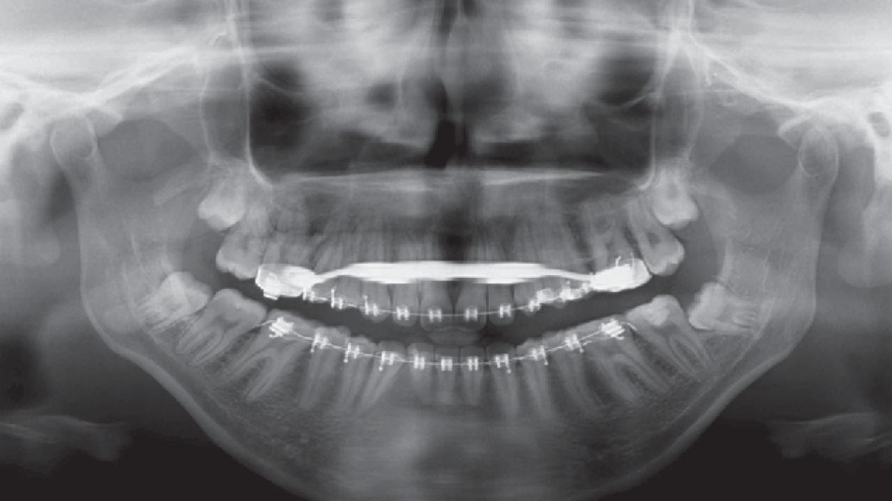 25-facts-about-orofaciodigital-type1