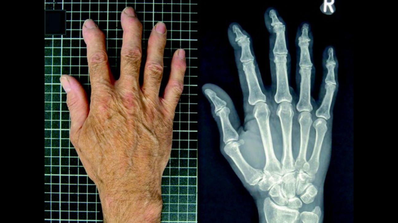 25-facts-about-osteoarthropathy-of-fingers-familial