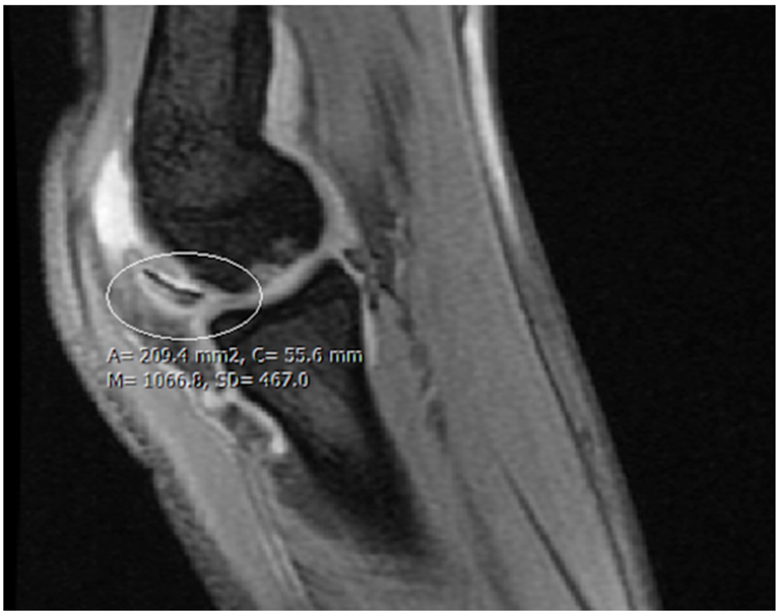 25-facts-about-osteochondritis-deformans-juvenile