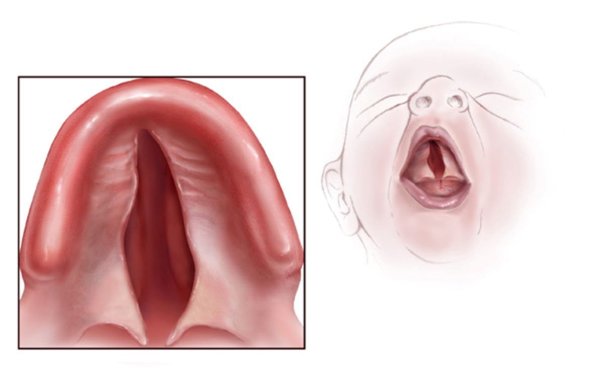 25-facts-about-oto-palatal-digital