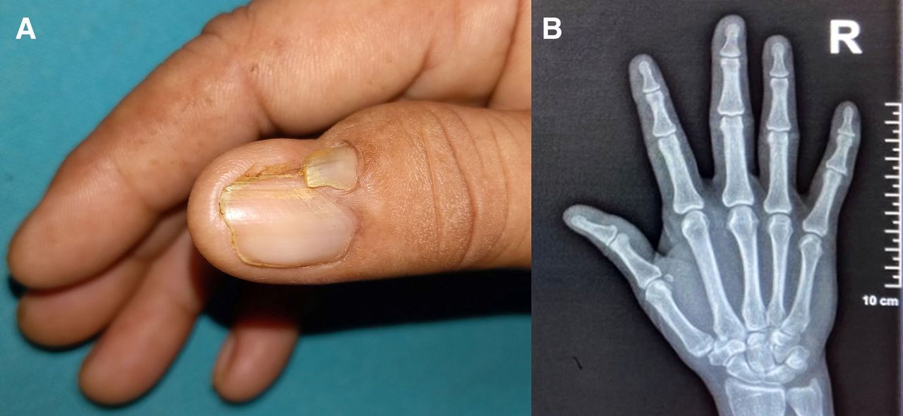 25-facts-about-otoonychoperoneal